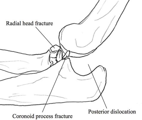 ramble elbow trite|Terrible Triad Injury of Elbow .
